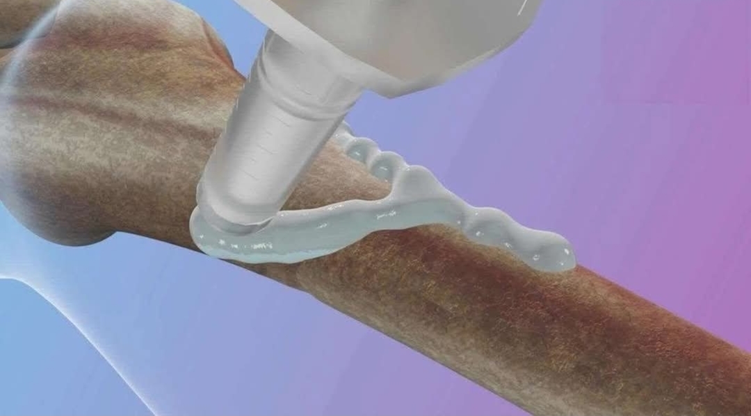 முறிந்த எலும்புகளை மூன்றே நிமிடத்தில் ஒட்ட வைக்கும் பசை கண்டுபிடிப்பு..!!