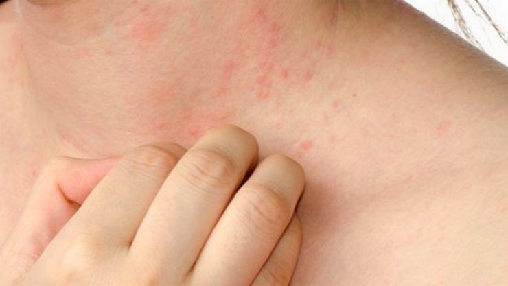 தோல் அரிப்புக்கு அற்புதமான 6 வீட்டு வைத்தியங்கள்..!!