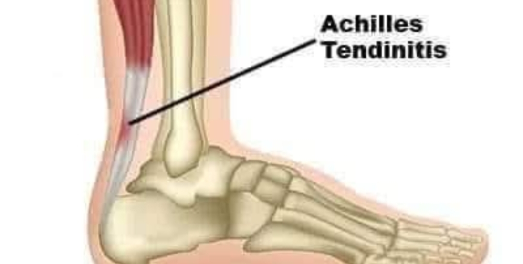 தாங்க முடியாத குதிகால் வலிக்கு அற்புத தீர்வுகள்..!!