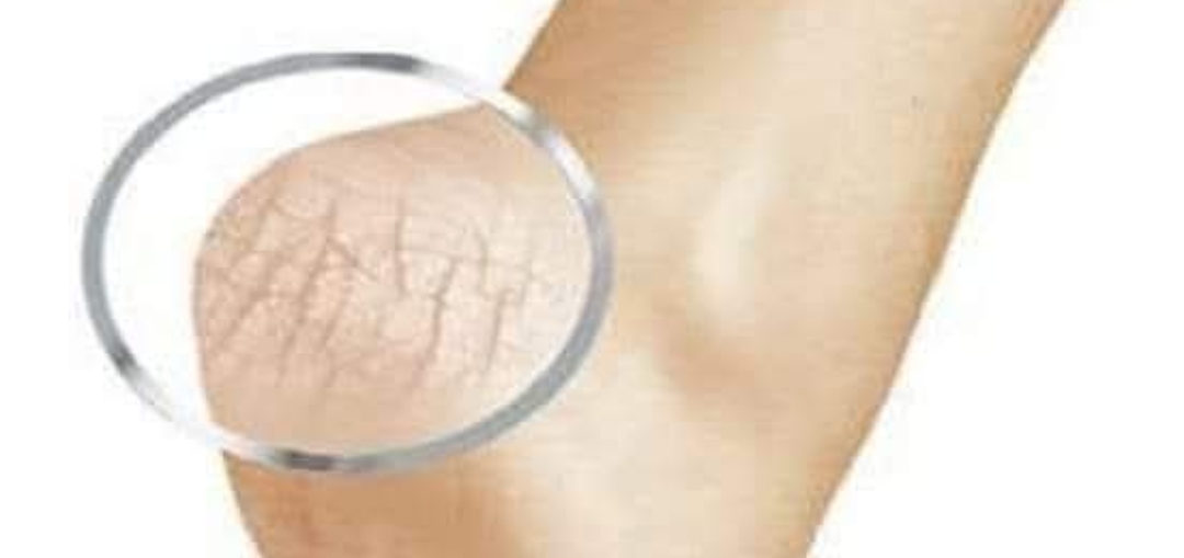 பித்த வெடிப்பு பற்றிய விழிப்புணர்வு பதிவு..!!