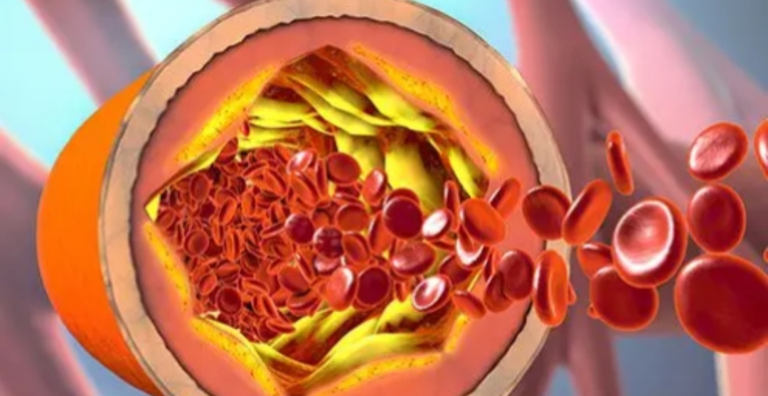 7 நாட்களில் கொலஸ்ட்ராலை குறைக்க இதை மட்டும் பண்ணுங்க போதும்..!!