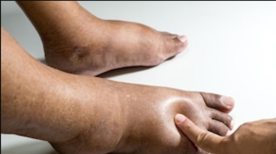 கால் வீக்கம் உள்ளவர்கள் இதை மட்டும் பண்ணினால் போதும்..!!