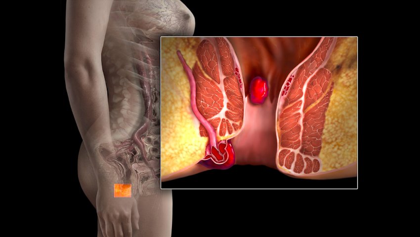 வெயில் காலத்தில் மூலநோய் வருவதற்கான காரணங்களும்.. தீர்வுகளும்..!!