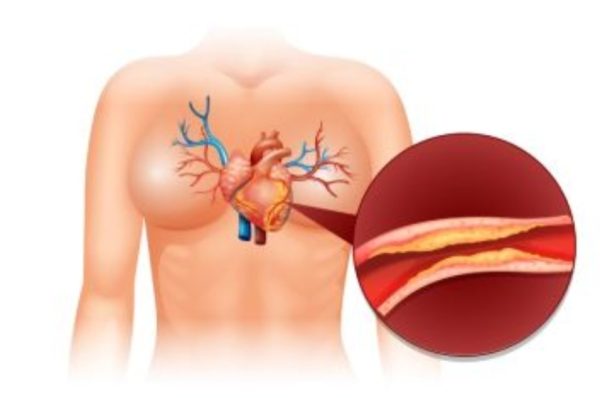 அதிக கொலஸ்ட்ரால் அறிகுறிகள் கவனிக்க வேண்டிய எச்சரிக்கை சிக்னல்கள் பற்றி தெரியுமா..??